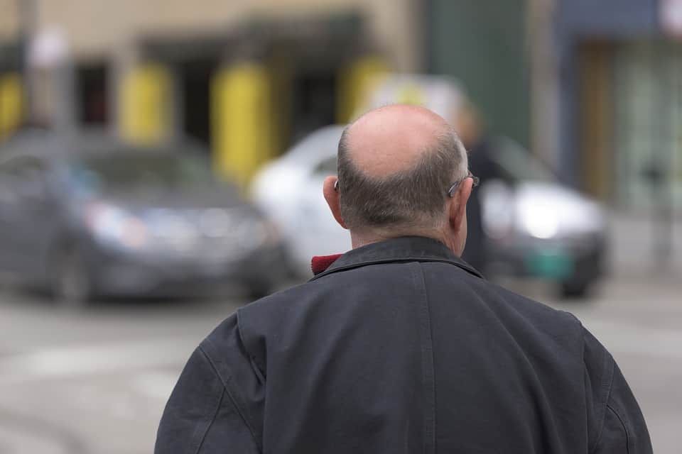 Scopri di più sull'articolo Trapianto capelli: cosa sapere?